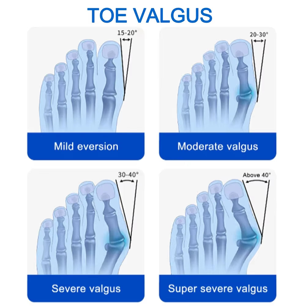 Bunion Splint Big Toe Straightener Hallux Valgus Correction Orthotics Foot Bone Thumb Adjuster Correction Bunions Corrector
