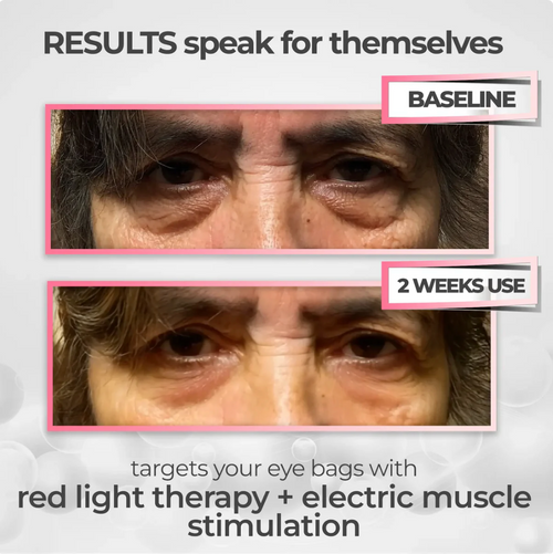 Optyx™ Red Light Therapy Glasses